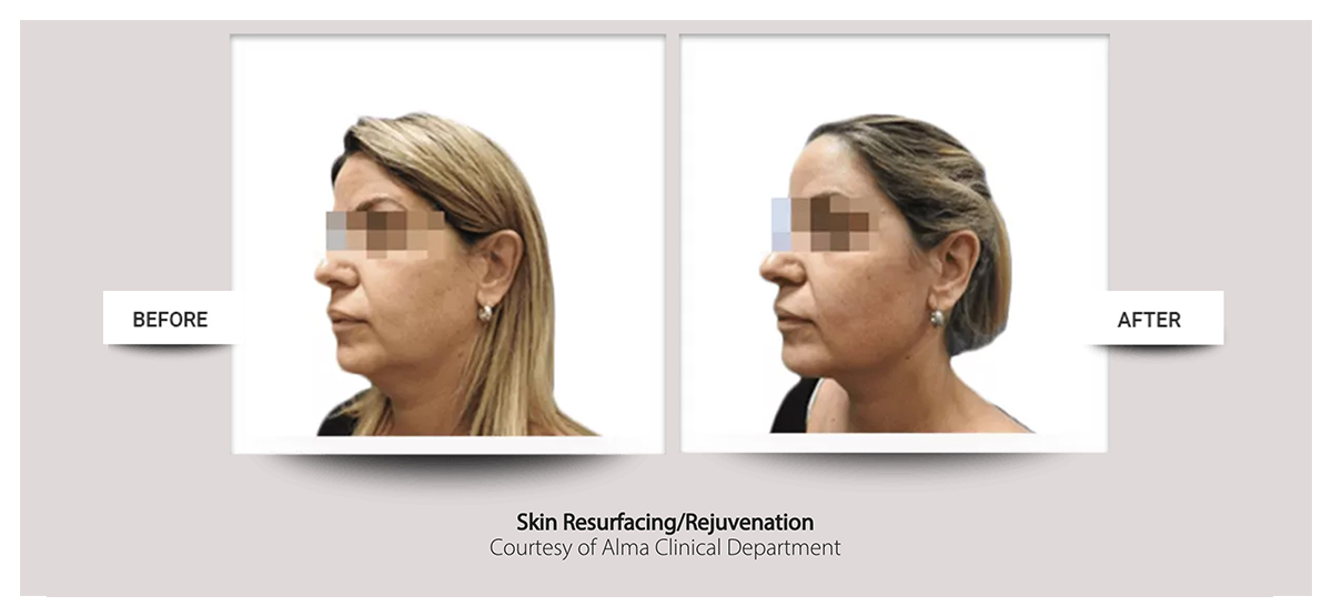 Accent Prime™ skin tightening, body contouring fast painless easy at Buckhead Plastic Surgery Atlanta GA