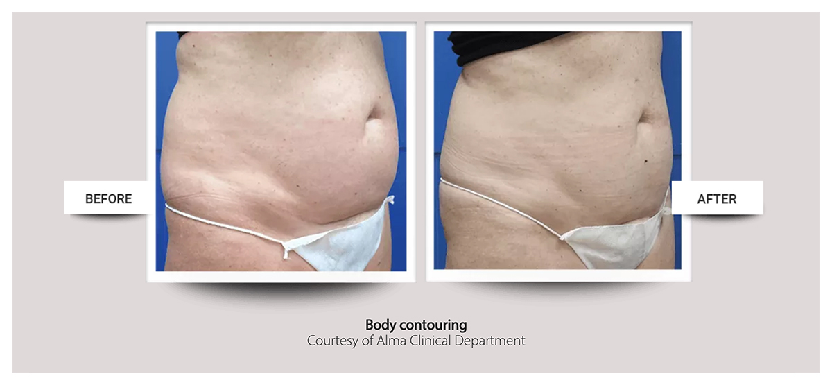 Accent Prime™ skin tightening, body contouring fast painless easy at Buckhead Plastic Surgery Atlanta GA