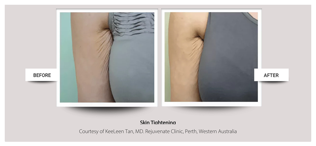 Accent Prime™ skin tightening, body contouring fast painless easy at Buckhead Plastic Surgery Atlanta GA