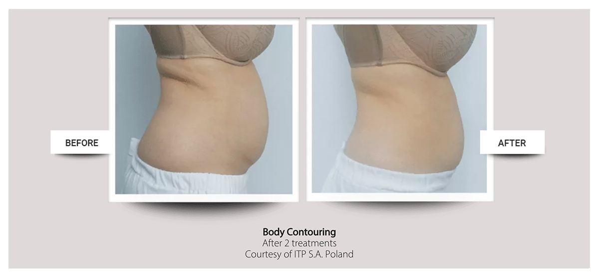 Accent Prime™ skin tightening, body contouring fast painless easy at Buckhead Plastic Surgery Atlanta GA