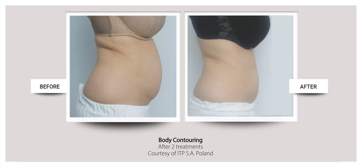 Accent Prime™ skin tightening, body contouring fast painless easy at Buckhead Plastic Surgery Atlanta GA