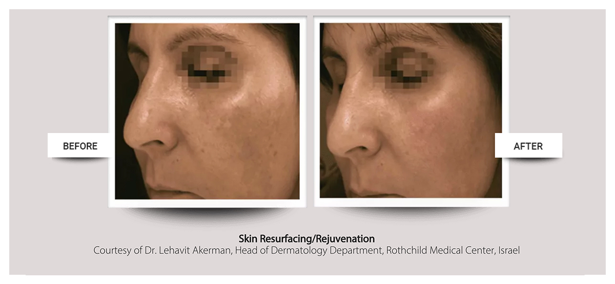 Accent Prime™ skin tightening, body contouring fast painless easy at Buckhead Plastic Surgery Atlanta GA