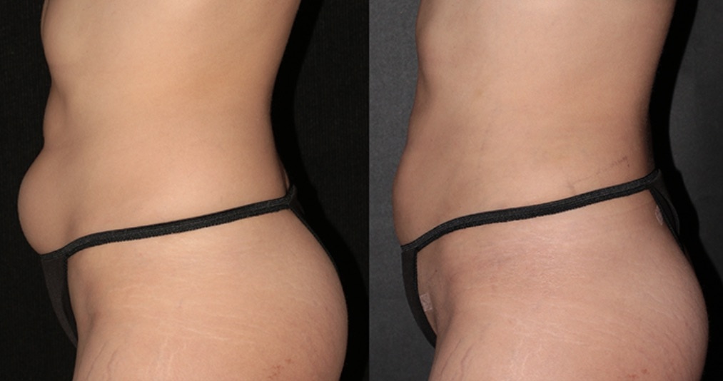 Beautifill Fat Transfer Lipo System by Alma Lasers at Buckhead Plastic Surgery Alan N Larsen, MD in Atlanta GA