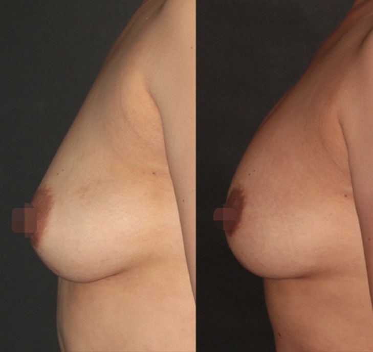 Beautifill Fat Transfer Lipo System by Alma Lasers at Buckhead Plastic Surgery Alan N Larsen, MD in Atlanta GA