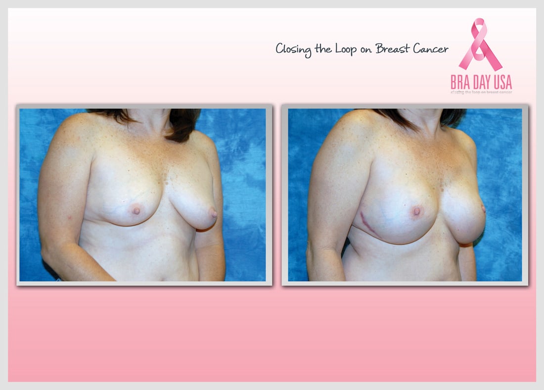 Before and After Photo Gallery | Breast Reconstruction | Buckhead Plastic Surgery | Alan N. Larsen, MD | Board-Certified Plastic Surgeon | Atlanta GA