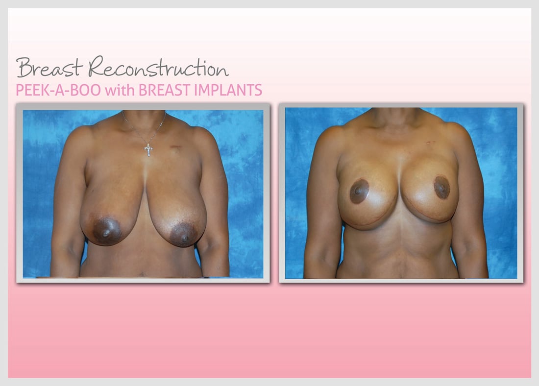 Before and After Photo Gallery | Breast Reconstruction | Buckhead Plastic Surgery | Alan N. Larsen, MD | Board-Certified Plastic Surgeon | Atlanta GA