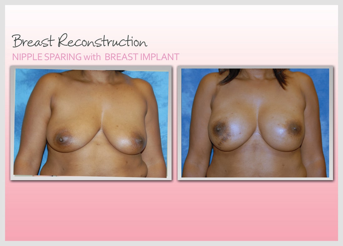 Before and After Photo Gallery | Breast Reconstruction | Buckhead Plastic Surgery | Alan N. Larsen, MD | Board-Certified Plastic Surgeon | Atlanta GA