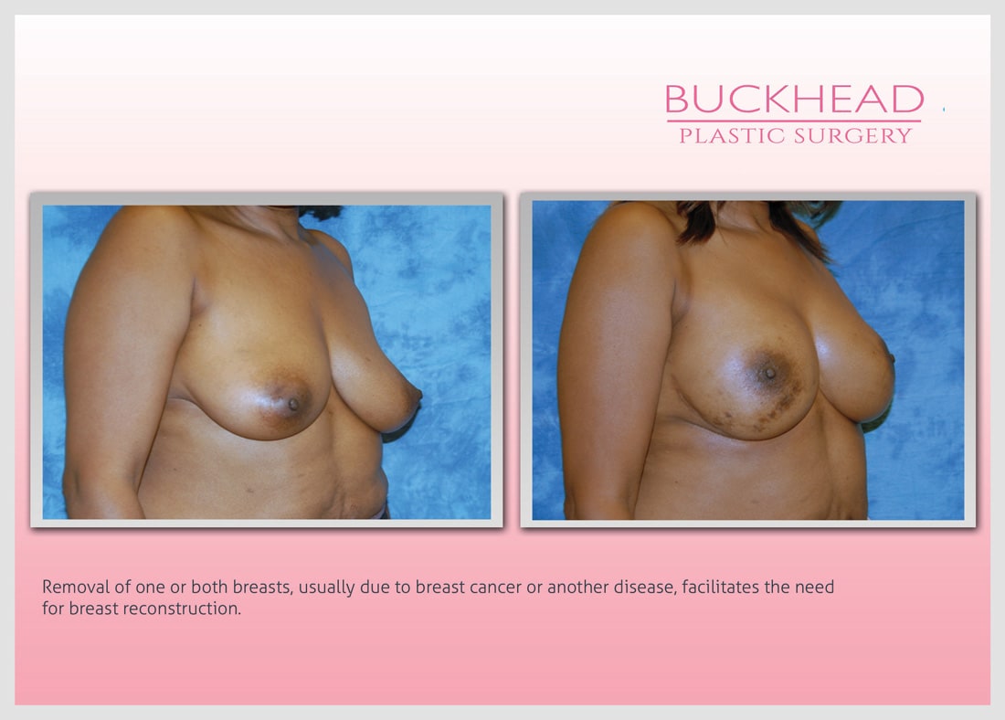 Before and After Photo Gallery | Breast Reconstruction | Buckhead Plastic Surgery | Alan N. Larsen, MD | Board-Certified Plastic Surgeon | Atlanta GA