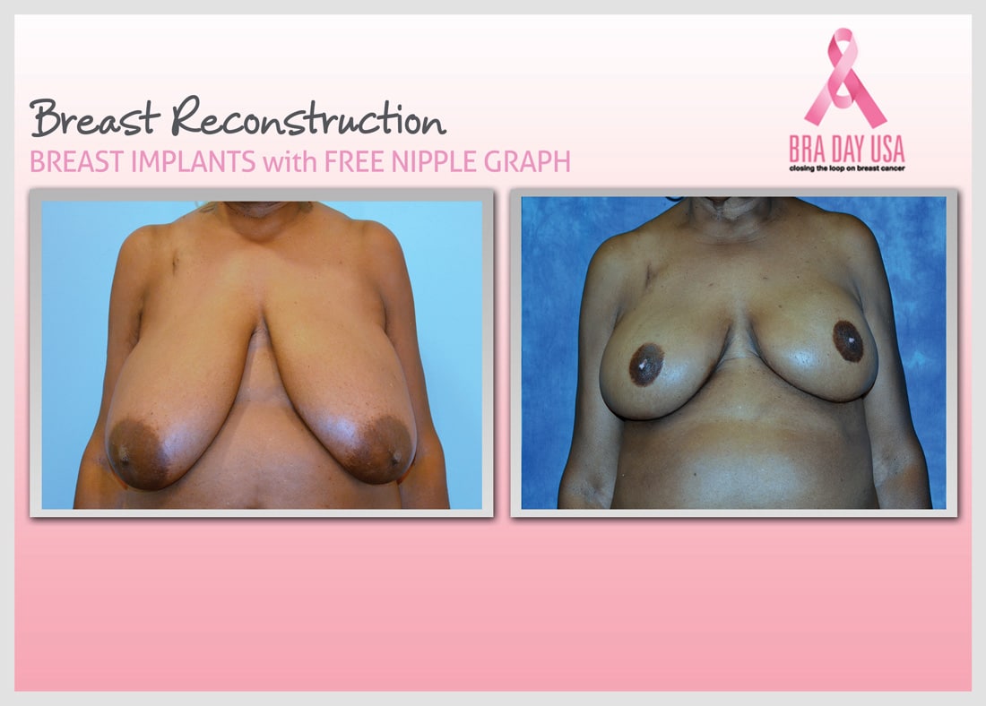 Before and After Photo Gallery | Breast Reconstruction | Buckhead Plastic Surgery | Alan N. Larsen, MD | Board-Certified Plastic Surgeon | Atlanta GA