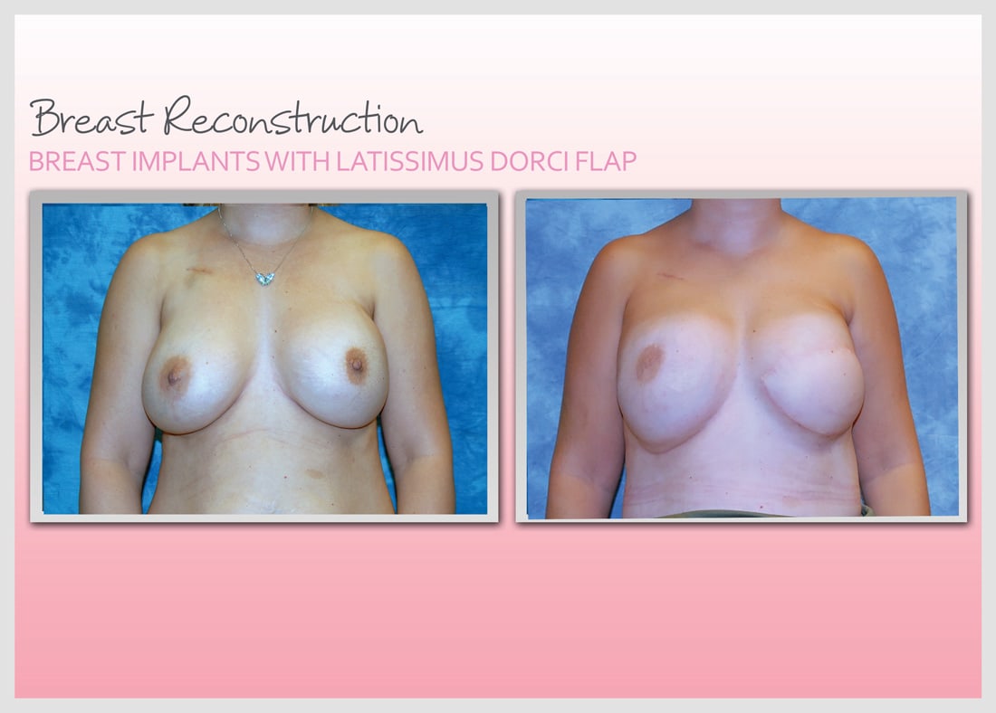 Before and After Photo Gallery | Breast Reconstruction | Buckhead Plastic Surgery | Alan N. Larsen, MD | Board-Certified Plastic Surgeon | Atlanta GA