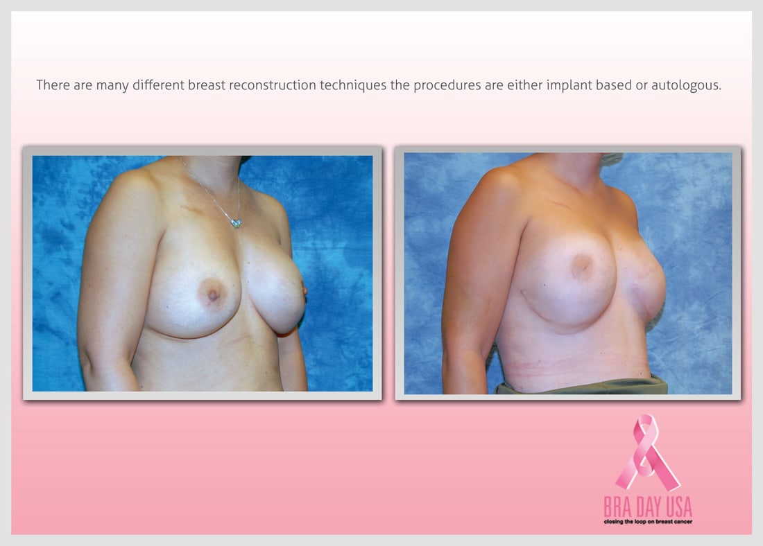 Before and After Photo Gallery | Breast Reconstruction | Buckhead Plastic Surgery | Alan N. Larsen, MD | Board-Certified Plastic Surgeon | Atlanta GA