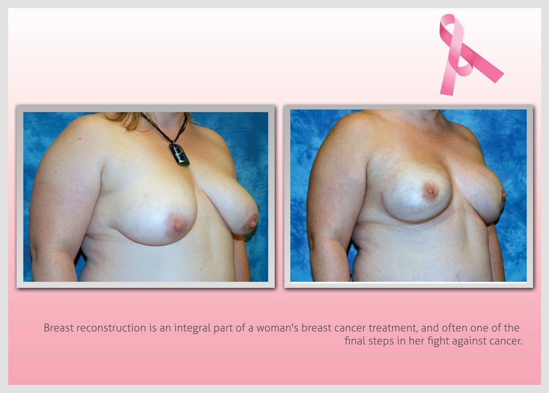 Before and After Photo Gallery | Breast Reconstruction | Buckhead Plastic Surgery | Alan N. Larsen, MD | Board-Certified Plastic Surgeon | Atlanta GA