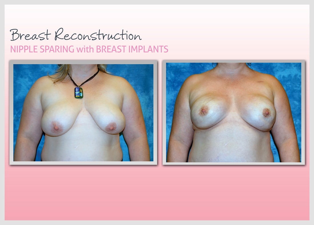 Before and After Photo Gallery | Breast Reconstruction | Buckhead Plastic Surgery | Alan N. Larsen, MD | Board-Certified Plastic Surgeon | Atlanta GA