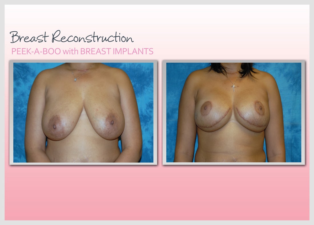 Before and After Photo Gallery | Breast Reconstruction | Buckhead Plastic Surgery | Alan N. Larsen, MD | Board-Certified Plastic Surgeon | Atlanta GA