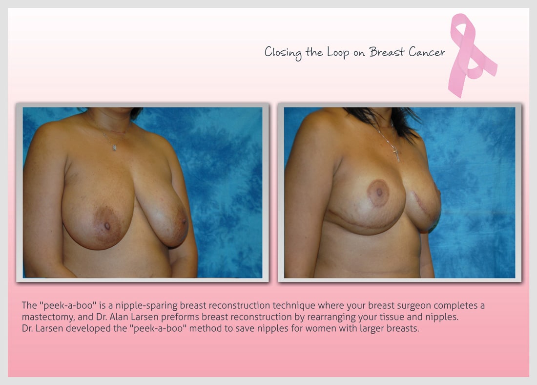 Before and After Photo Gallery | Breast Reconstruction | Buckhead Plastic Surgery | Alan N. Larsen, MD | Board-Certified Plastic Surgeon | Atlanta GA