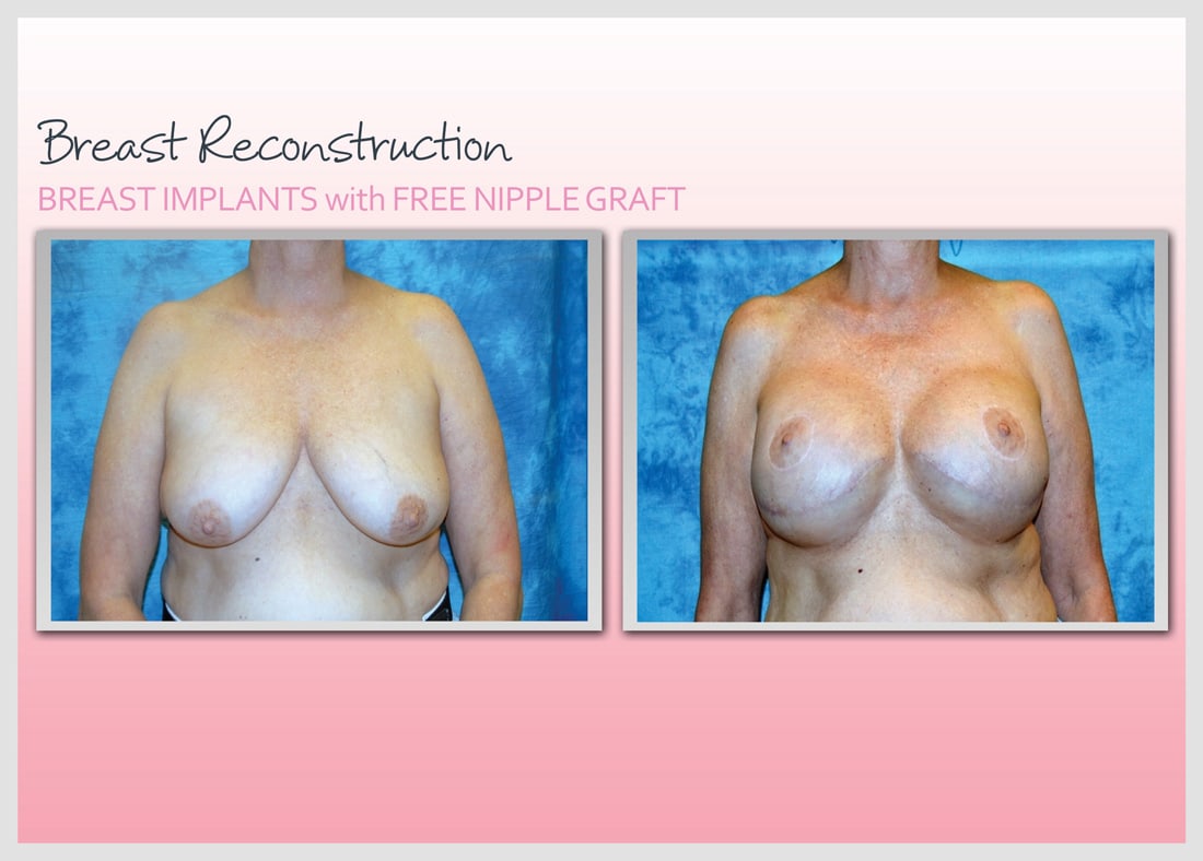 Before and After Photo Gallery | Breast Reconstruction | Buckhead Plastic Surgery | Alan N. Larsen, MD | Board-Certified Plastic Surgeon | Atlanta GA