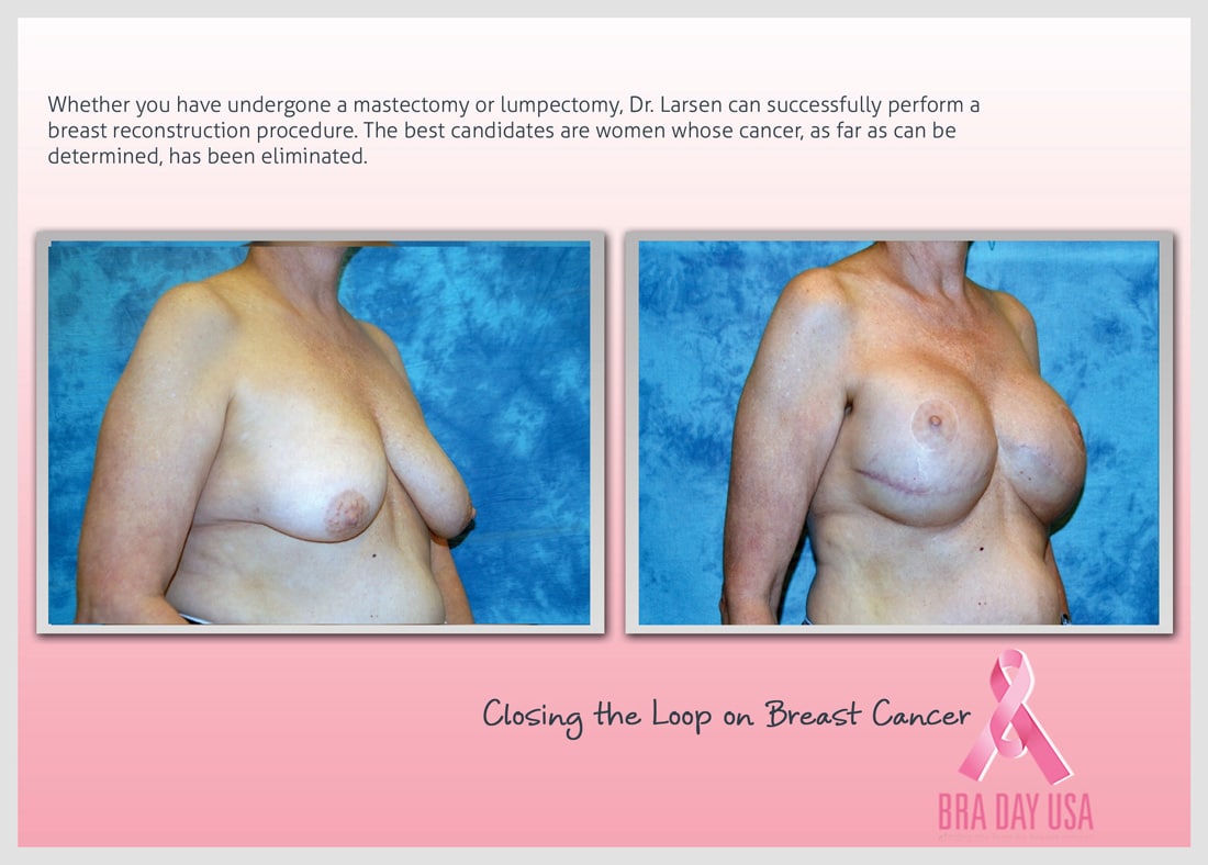 Before and After Photo Gallery | Breast Reconstruction | Buckhead Plastic Surgery | Alan N. Larsen, MD | Board-Certified Plastic Surgeon | Atlanta GA