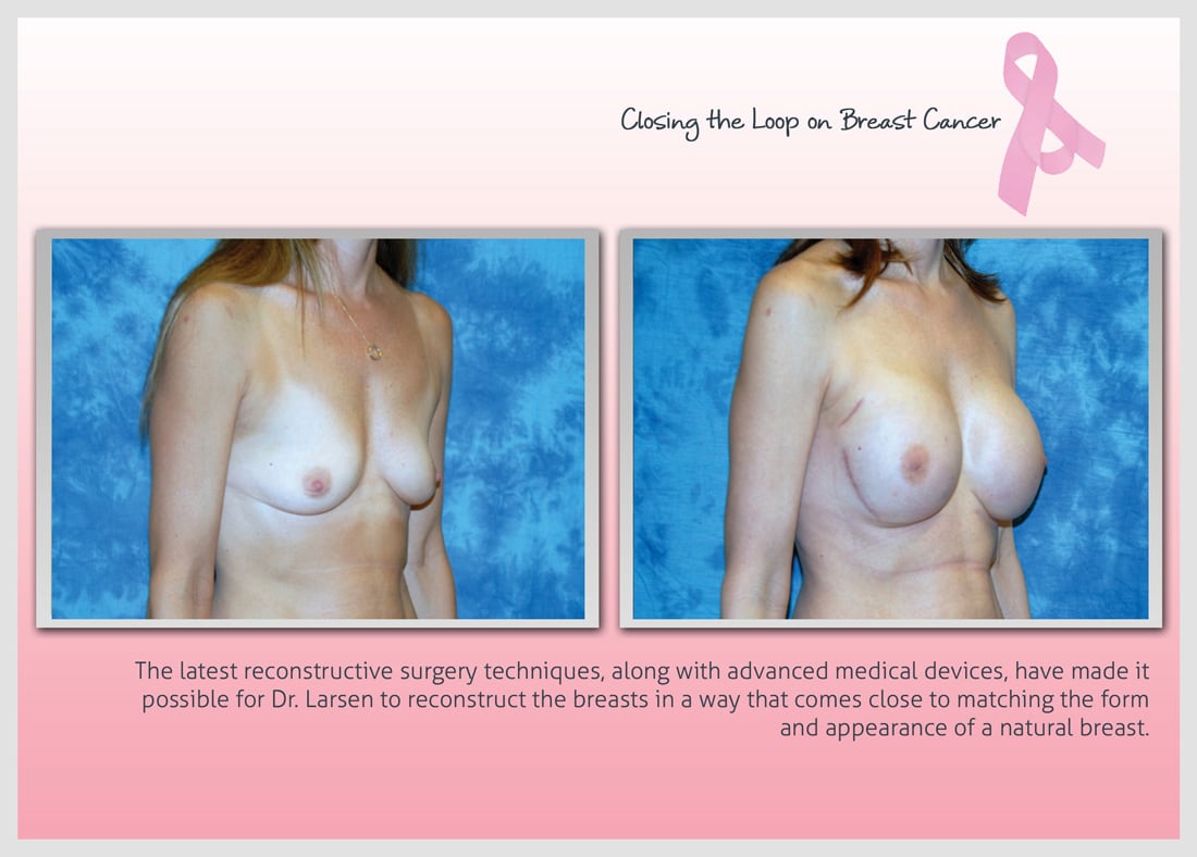 Before and After Photo Gallery | Breast Reconstruction | Buckhead Plastic Surgery | Alan N. Larsen, MD | Board-Certified Plastic Surgeon | Atlanta GA