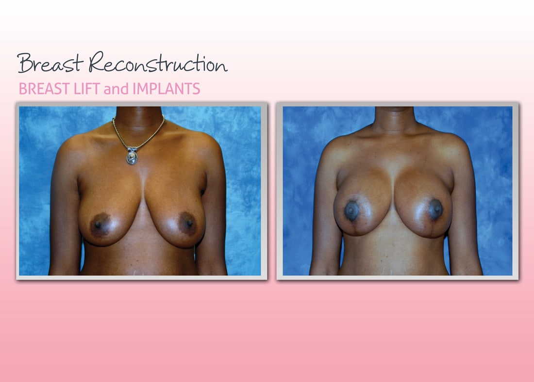 Before and After Photo Gallery | Breast Reconstruction | Buckhead Plastic Surgery | Alan N. Larsen, MD | Board-Certified Plastic Surgeon | Atlanta GA