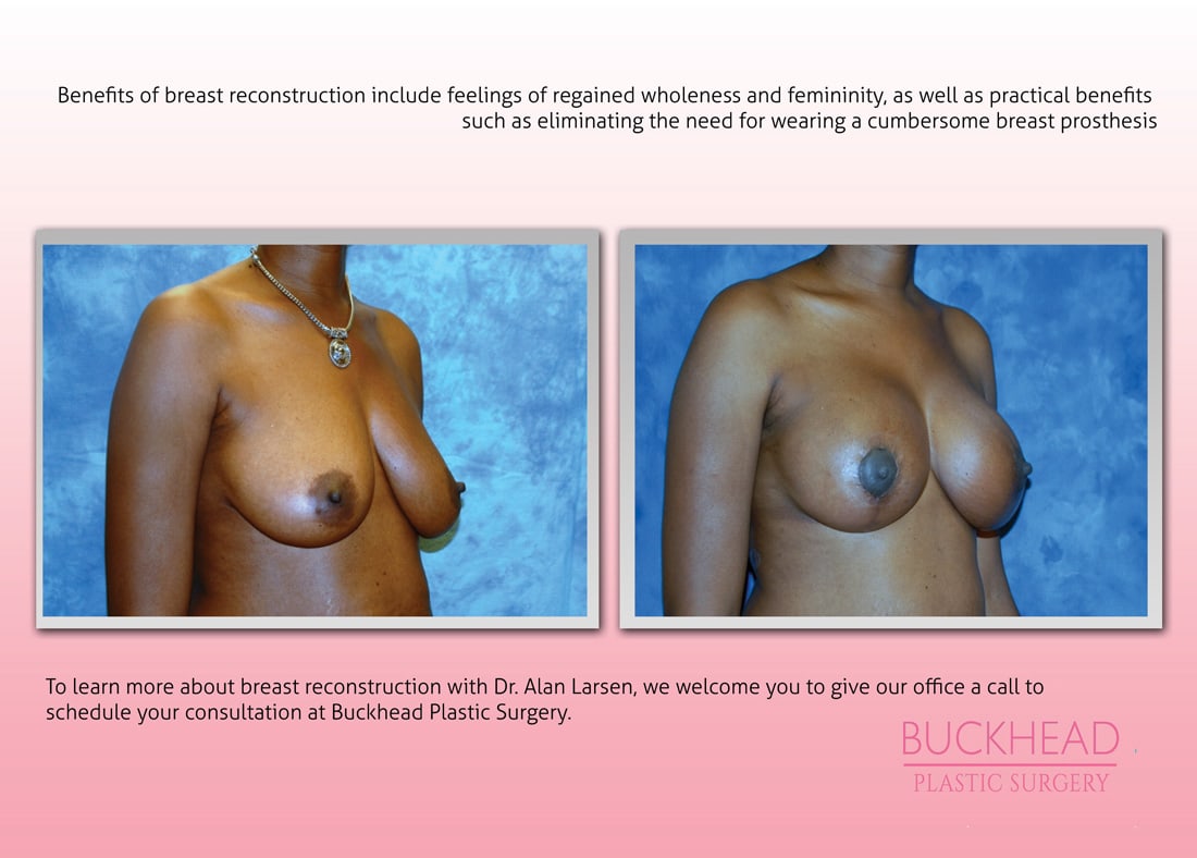 Before and After Photo Gallery | Breast Reconstruction | Buckhead Plastic Surgery | Alan N. Larsen, MD | Board-Certified Plastic Surgeon | Atlanta GA