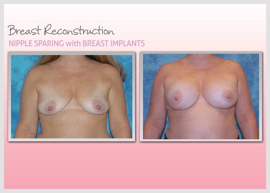 Before and After Photo Gallery | Breast Reconstruction | Buckhead Plastic Surgery | Alan N. Larsen, MD | Board-Certified Plastic Surgeon | Atlanta GA