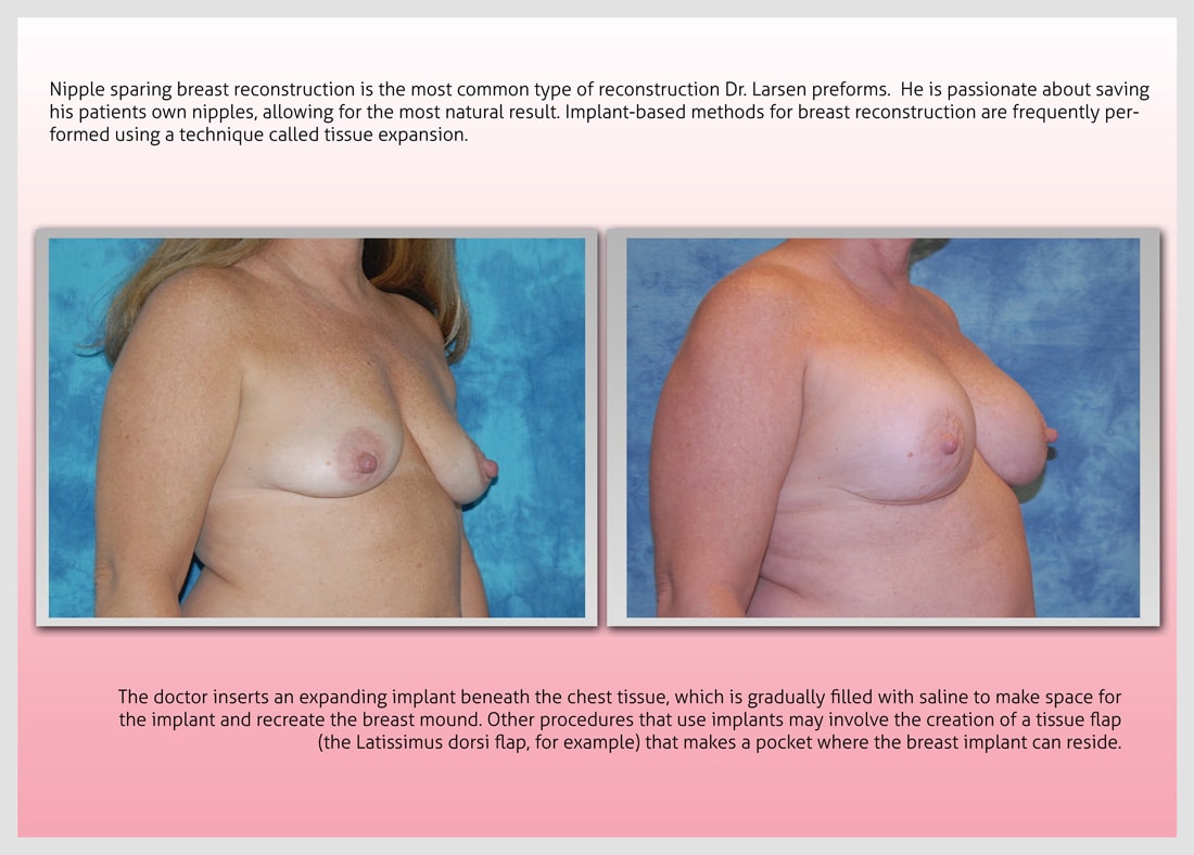 Before and After Photo Gallery | Breast Reconstruction | Buckhead Plastic Surgery | Alan N. Larsen, MD | Board-Certified Plastic Surgeon | Atlanta GA