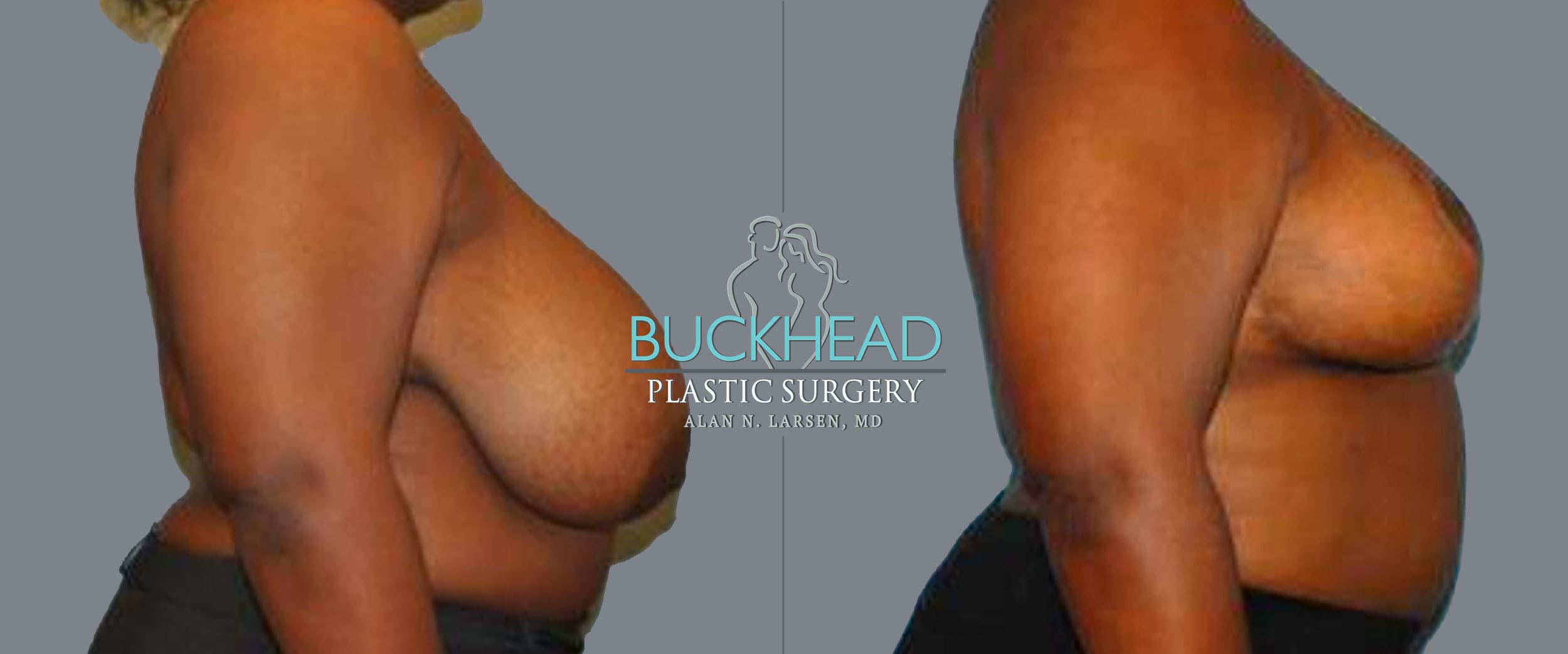 Before and After Photo Gallery | Breast Reduction | Buckhead Plastic Surgery | Alan N. Larsen, MD | Board-Certified Plastic Surgeon | Atlanta GA