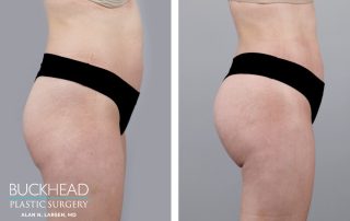 Before and After Photo Gallery | Fat Transfer BBL with Beautifill | LUX Med Spa at Buckhead Plastic Surgery | Alan N. Larsen, MD | Board-Certified Plastic Surgeon | Atlanta GA