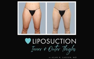 Before-and-After-Photo-Gallery-liposuction-Buckhead-Plastic-Surgery-Alan-N.-Larsen,-MD-Board-Certified-Plastic-Surgeon-Atlanta-GA-Inner-Thighs-Front