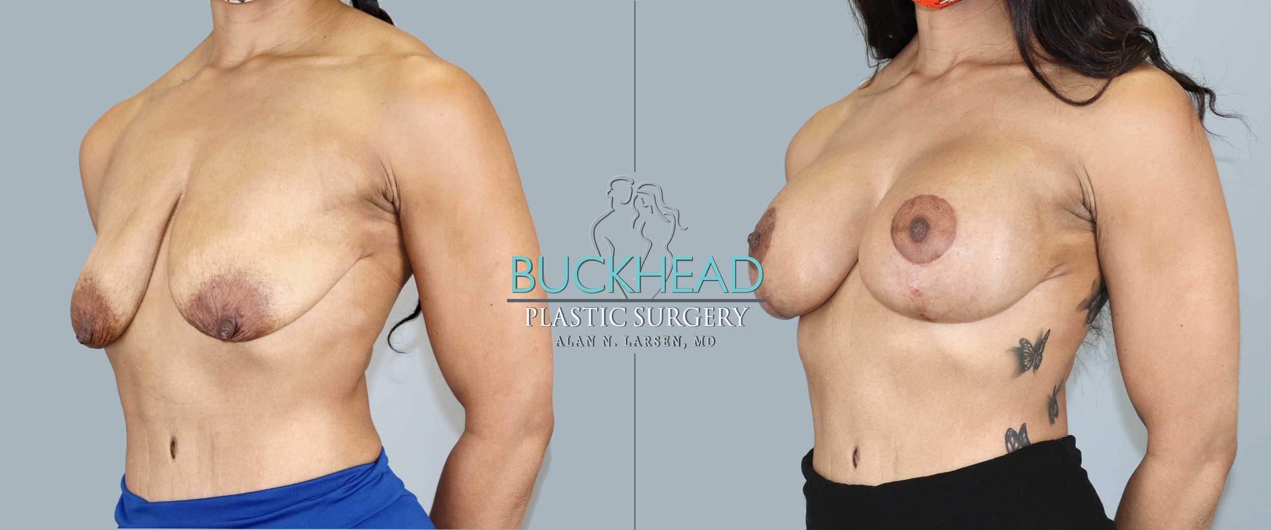 Before and After Photo Gallery | Breast Lift with Augmentation | Buckhead Plastic Surgery | Alan N. Larsen, MD | Board-Certified Plastic Surgeon | Atlanta GA