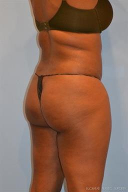 Liposuction | Buckhead Plastic Surgery | Board-Certified Plastic Surgeon in Atlanta GA