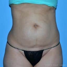 Liposuction | Buckhead Plastic Surgery | Board-Certified Plastic Surgeon in Atlanta GA