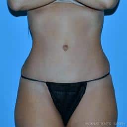 Liposuction | Buckhead Plastic Surgery | Board-Certified Plastic Surgeon in Atlanta GA