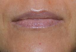 Lip Enhancement | Buckhead Plastic Surgery | Board-Certified Plastic Surgeon in Atlanta GA