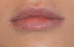 Lip Enhancement | Buckhead Plastic Surgery | Board-Certified Plastic Surgeon in Atlanta GA