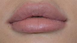 Lip Enhancement | Buckhead Plastic Surgery | Board-Certified Plastic Surgeon in Atlanta GA