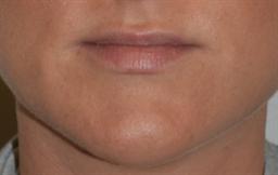 Lip Enhancement | Buckhead Plastic Surgery | Board-Certified Plastic Surgeon in Atlanta GA