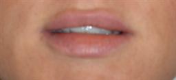 Lip Enhancement | Buckhead Plastic Surgery | Board-Certified Plastic Surgeon in Atlanta GA