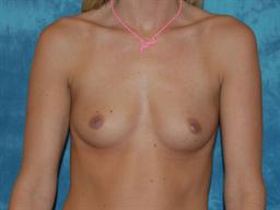 Breast Augmentation | Buckhead Plastic Surgery | Board-Certified Plastic Surgeon in Atlanta GA