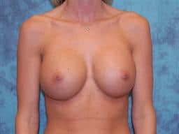 Breast Augmentation | Buckhead Plastic Surgery | Board-Certified Plastic Surgeon in Atlanta GA