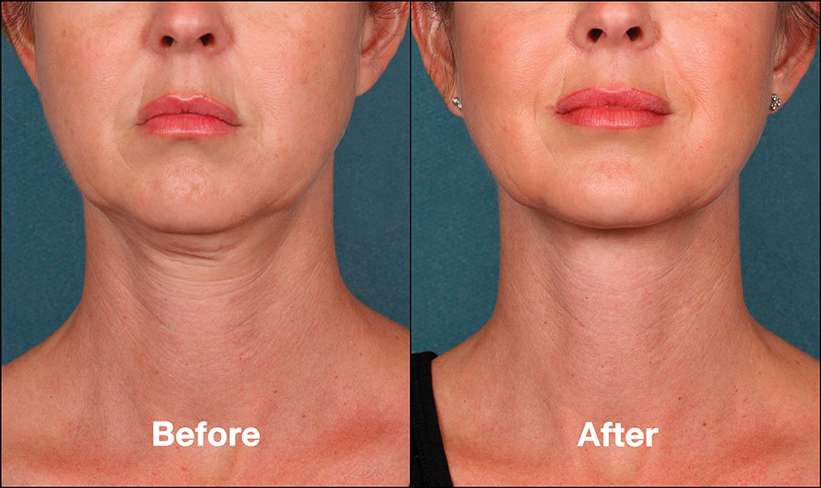 Liquid Lift | Buckhead Plastic Surgery - Northeast Atlanta