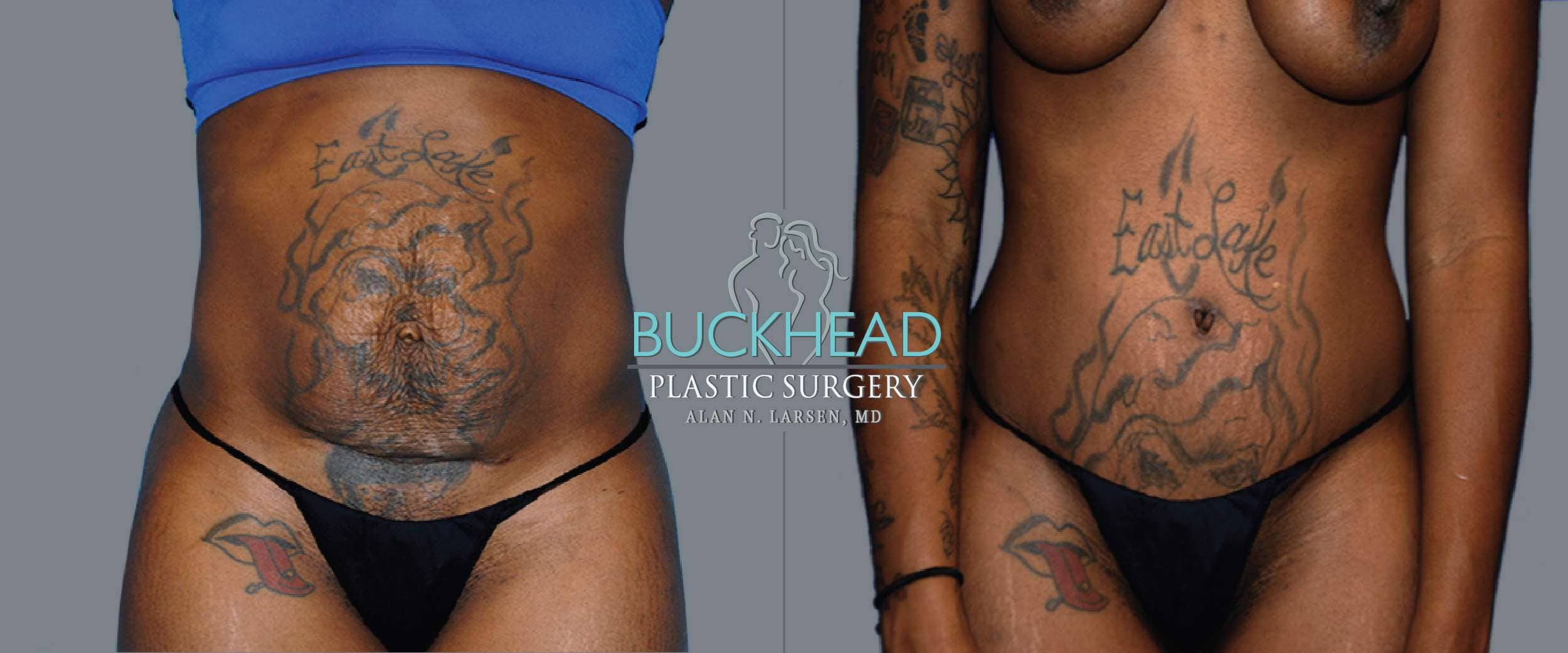 Before and After Photo gallery | Tummy Tuck | Buckhead Plastic Surgery | Double Board-Certified Plastic Surgeon in Atlanta GA