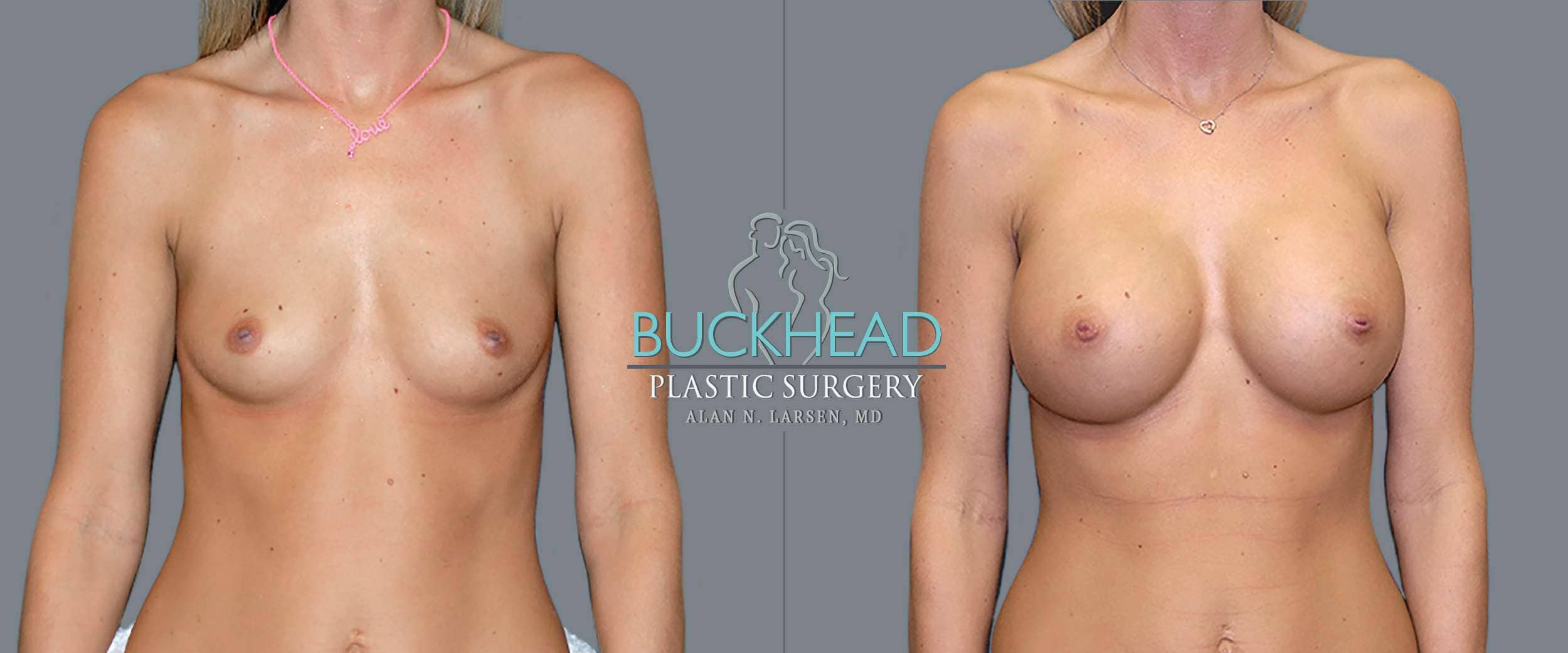 Before and After Photo gallery | Breast Augmentation | Buckhead Plastic Surgery | Double Board-Certified Plastic Surgeon in Atlanta GA