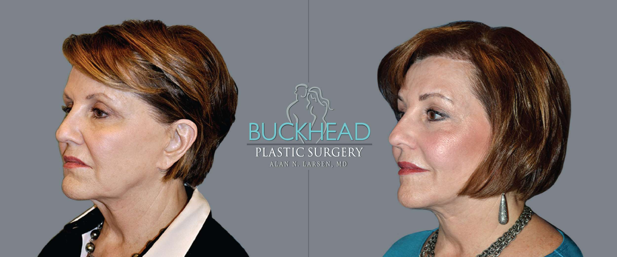 Before and After Photo Gallery | Blepharosty | Buckhead Plastic Surgery | Alan N. Larsen, MD | Double Board-Certified Plastic Surgeon | Atlanta GA