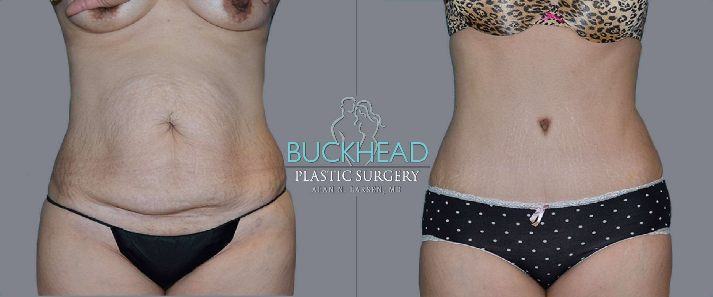 Before and After Photo gallery | Tummy Tuck | Buckhead Plastic Surgery | Double Board-Certified Plastic Surgeon in Atlanta GA