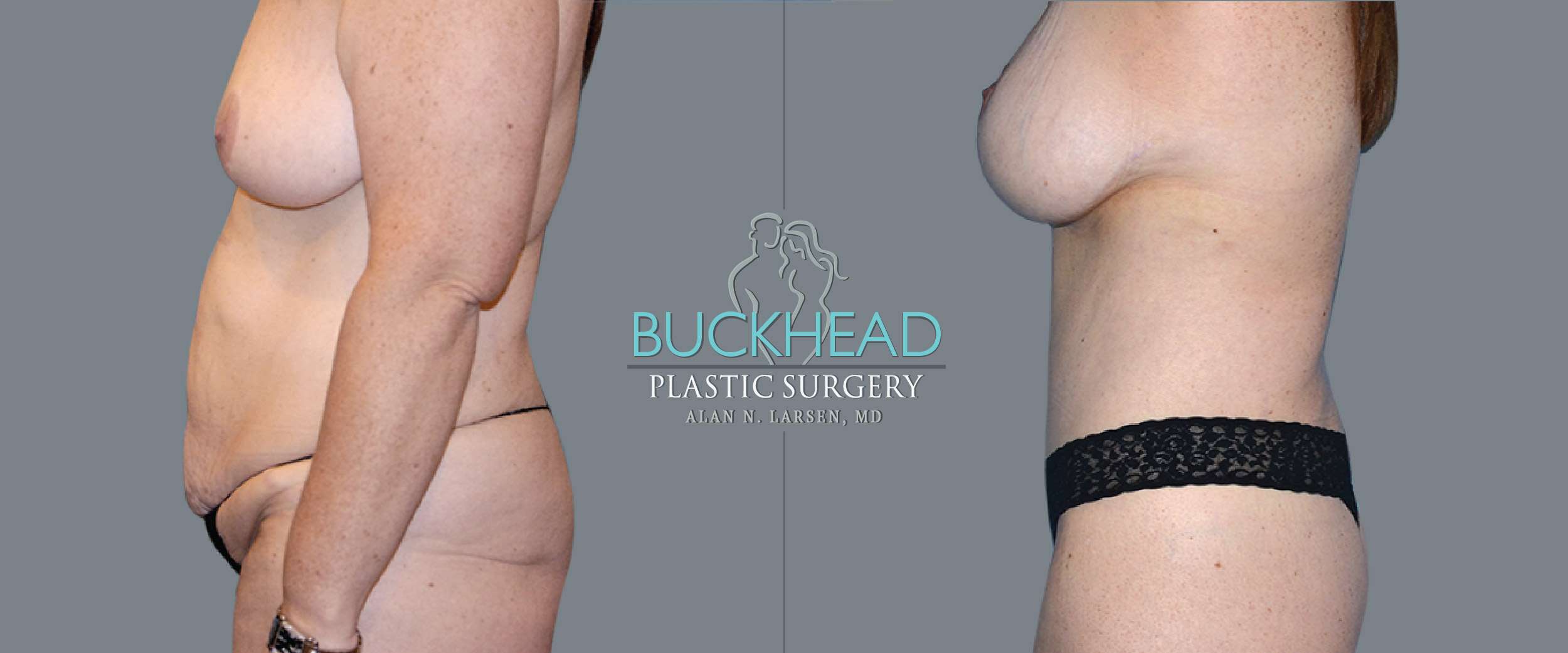 Before and After Photo gallery | Body Lift | Buckhead Plastic Surgery | Double Board-Certified Plastic Surgeon in Atlanta GA