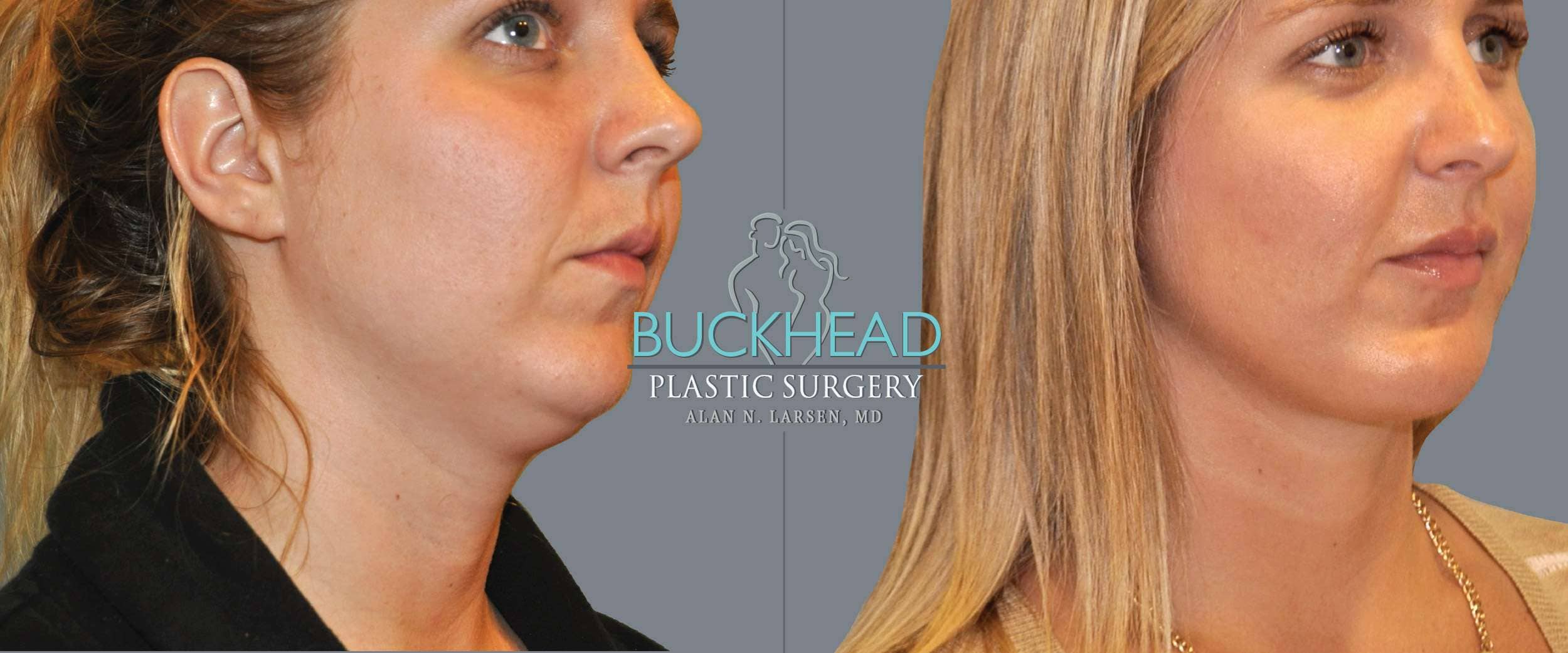 Before and After Photo Gallery | Liposuction - Neck | Buckhead Plastic Surgery | Alan N. Larsen, MD | Double Board-Certified Plastic Surgeon | Atlanta GA