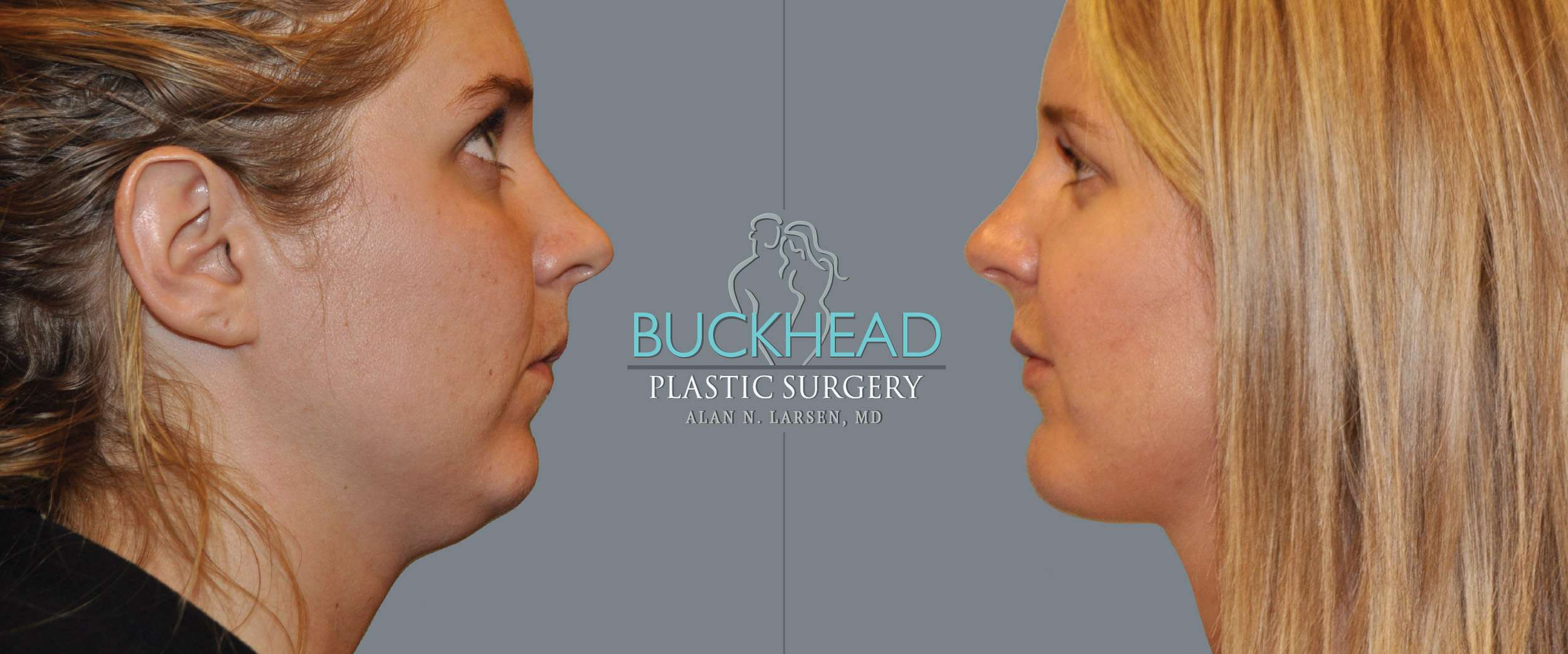 Before and After Photo Gallery | Liposuction - Neck | Buckhead Plastic Surgery | Alan N. Larsen, MD | Double Board-Certified Plastic Surgeon | Atlanta GA