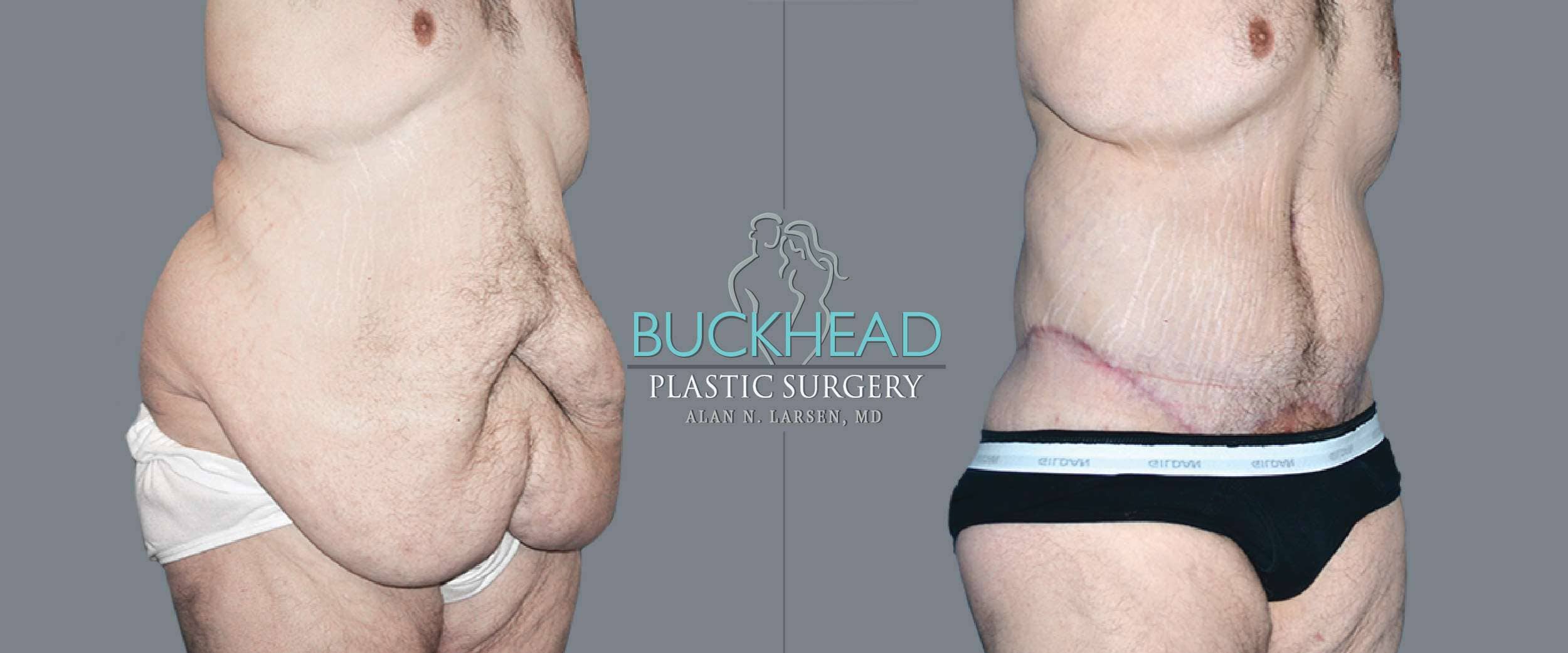 Before and After Photo gallery | Body Lift | Buckhead Plastic Surgery | Double Board-Certified Plastic Surgeon in Atlanta GA