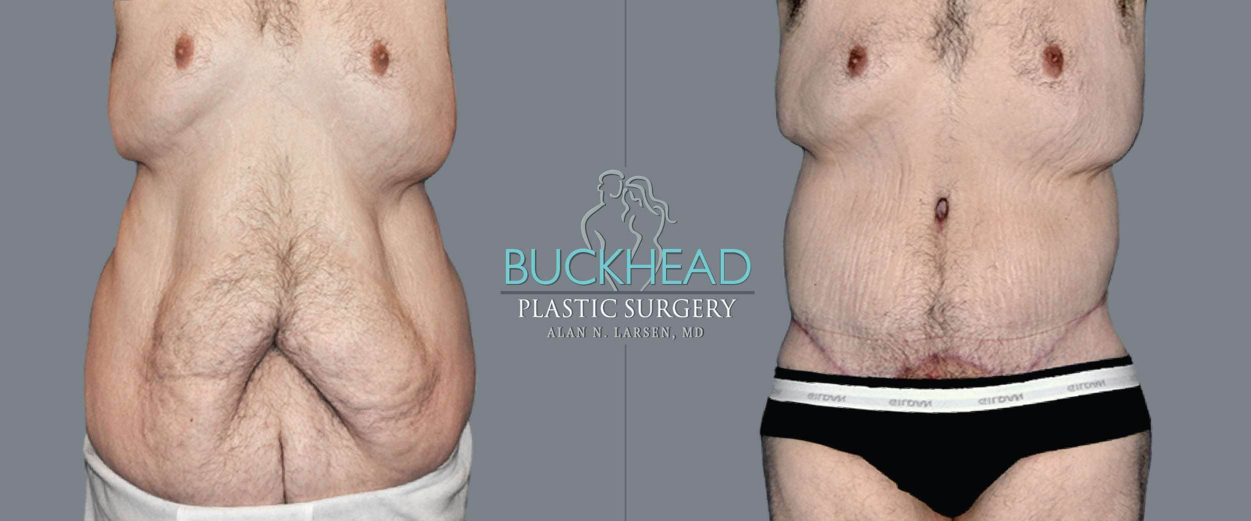 Before and After Photo gallery | Body Lift | Buckhead Plastic Surgery | Double Board-Certified Plastic Surgeon in Atlanta GA